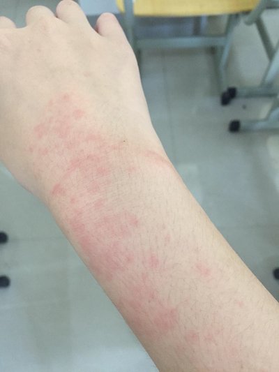 皮肤得了皮炎发痒怎么办