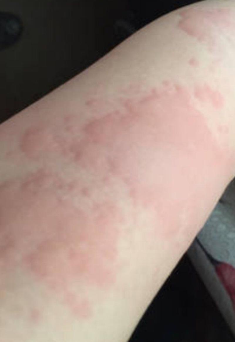得了荨麻疹该怎么办