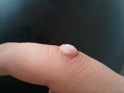 泉州晋江市看扁平疣的皮肤门诊部