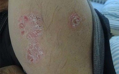 泉州丰泽区银屑病治疗的医院有哪些
