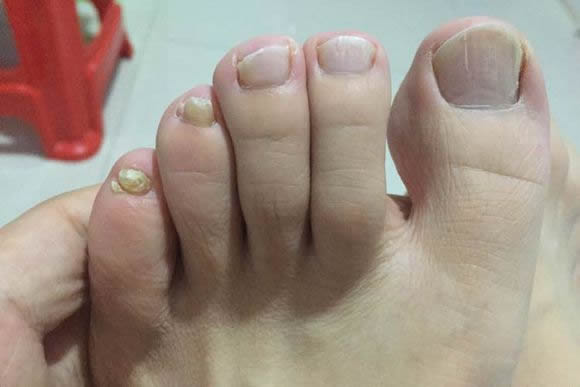 原来患上灰指甲都是真菌惹的祸